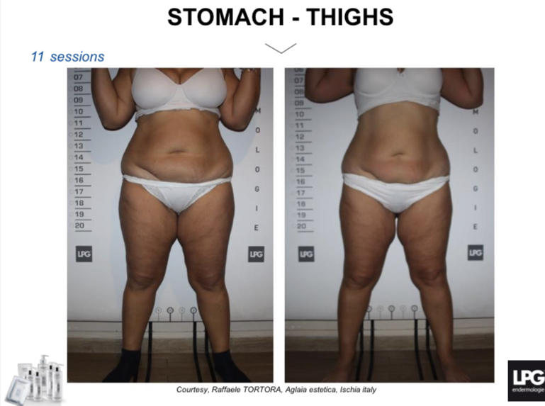 Smooth Cellulite – LPG endermologie